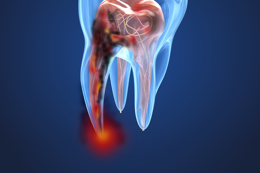 歯髄炎・根尖性歯周炎