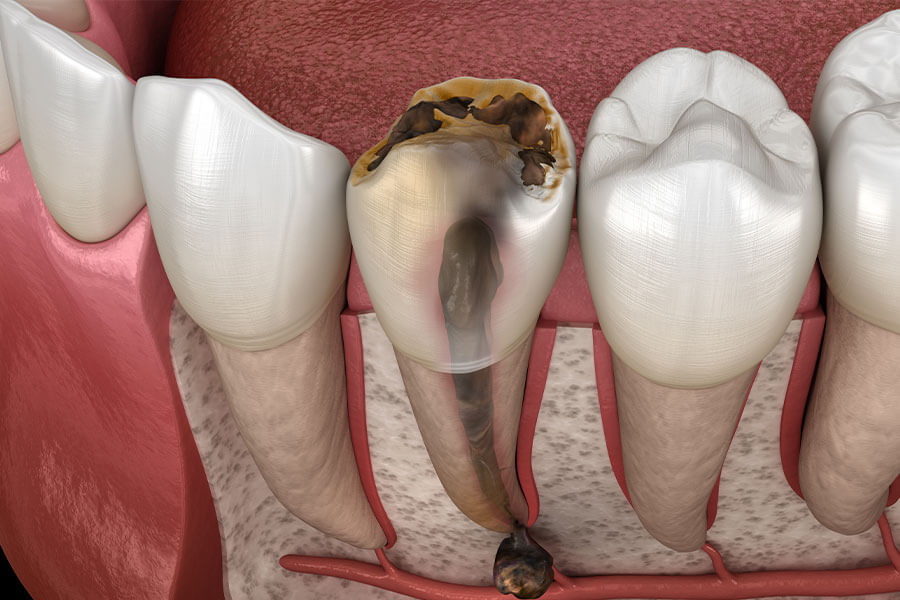 歯の根っこに膿が
溜まってしまっている歯