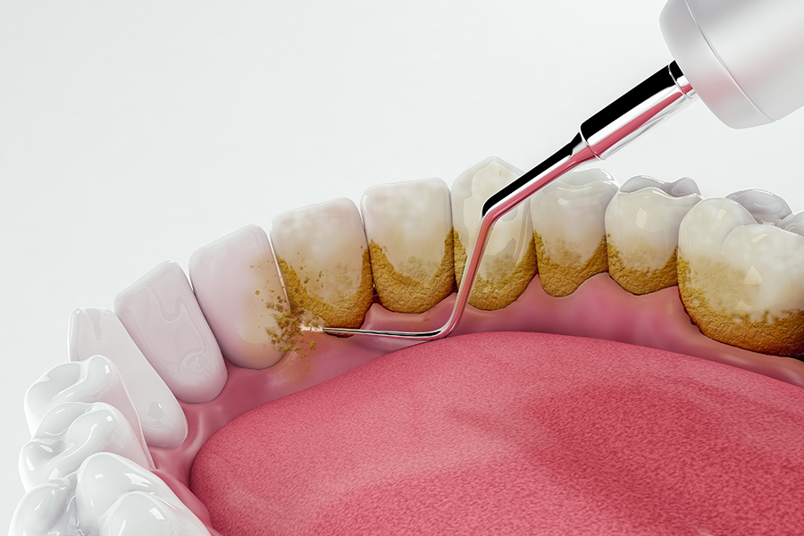 歯石やバイオフィルムについて