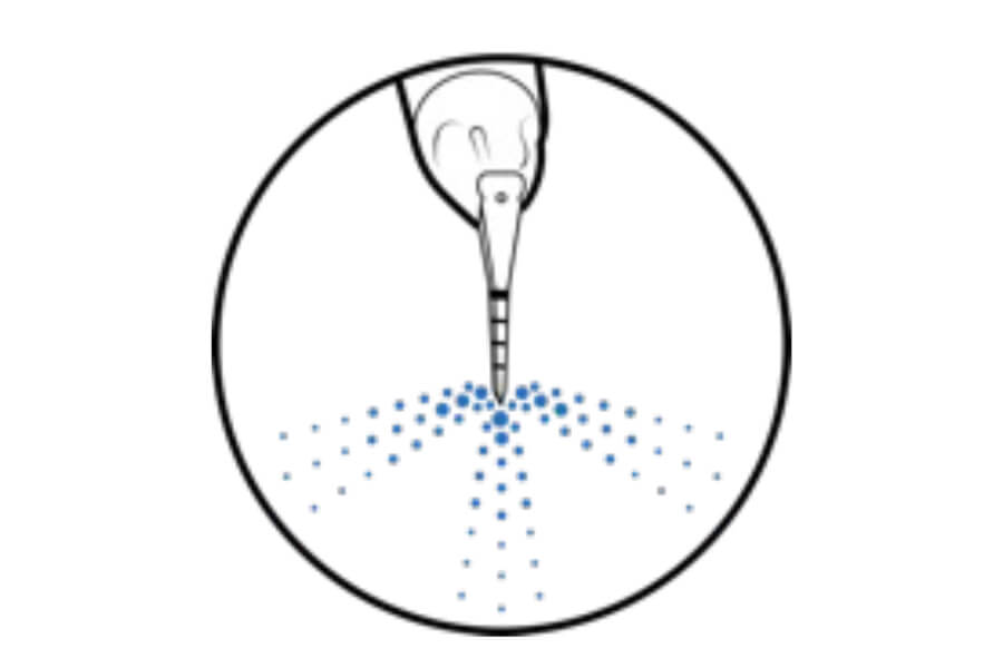 歯肉縁下のペリオフロー
